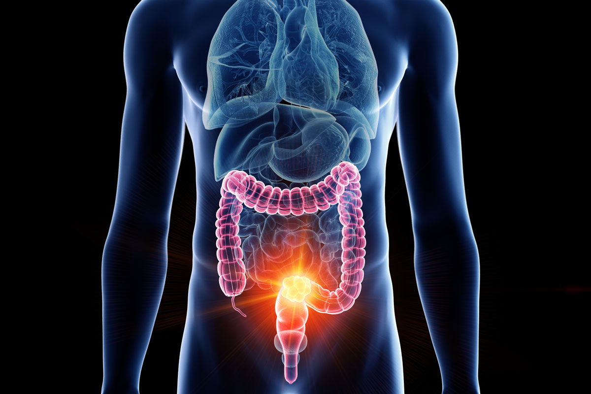 Colon Cancer: What You Should Know | Blogs